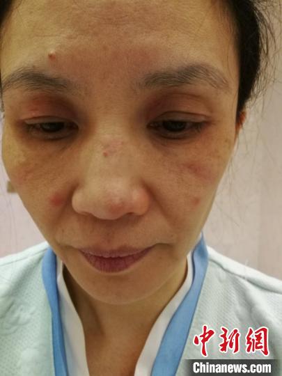 熊衍峰是江西支援武汉防疫队检验组唯一的女同志，今年45岁的她，脸上因为长期戴口罩过敏出现了红斑。受访者供图